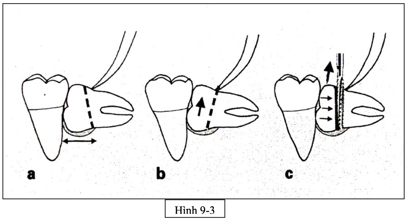 Tiểu phẫu răng khôn nghiêng gần 90 độ